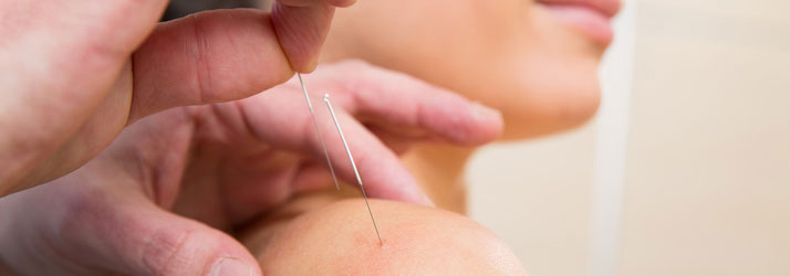 Chiropractic Calgary AB About Acupuncture